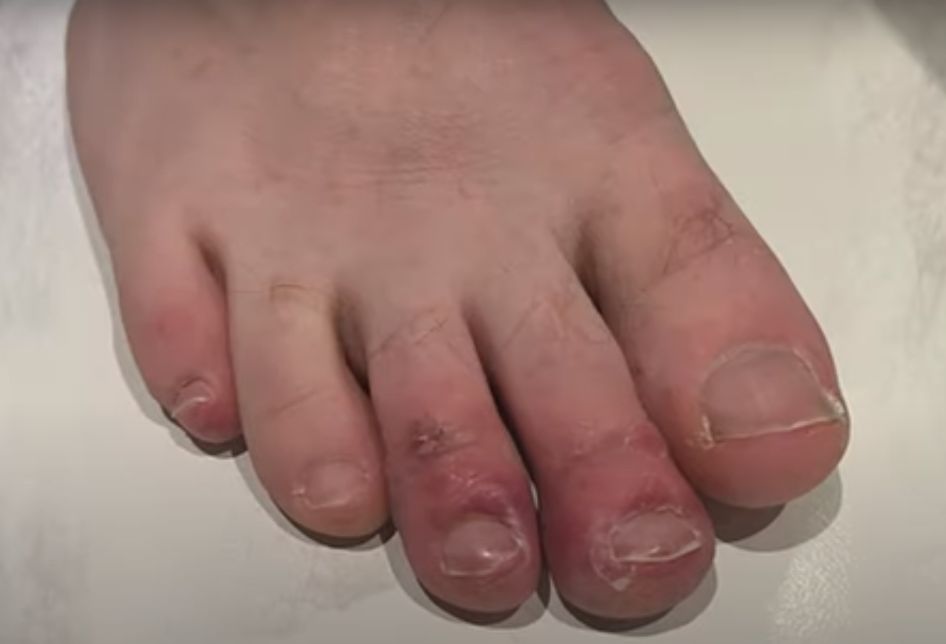 Chilblains